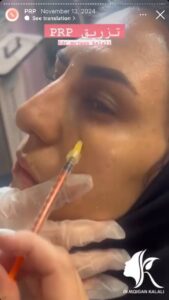 نمونه کار پی آر پی دکتر مژگان کلالی در مشهد
