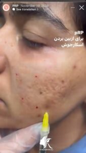 نمونه کار پی آر پی دکتر مژگان کلالی در مشهد