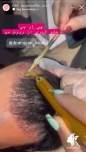 نمونه کار پی آر پی دکتر مژگان کلالی در مشهد