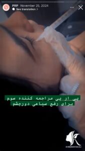 نمونه کار پی آر پی دکتر مژگان کلالی در مشهد