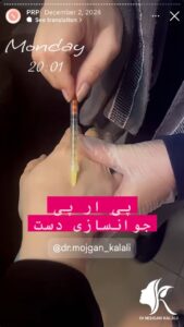 نمونه کار پی آر پی دکتر مژگان کلالی در مشهد
