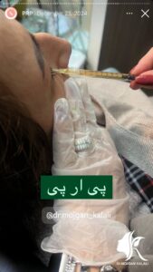 نمونه کار پی آر پی دکتر مژگان کلالی در مشهد
