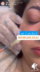 نمونه کار پی آر پی دکتر مژگان کلالی در مشهد