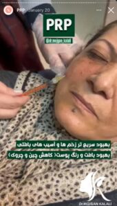 نمونه کار پی آر پی دکتر مژگان کلالی در مشهد