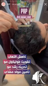 نمونه کار پی آر پی دکتر مژگان کلالی در مشهد