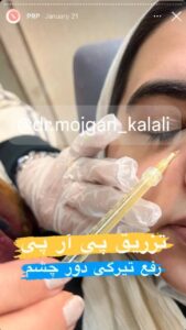 نمونه کار پی آر پی دکتر مژگان کلالی در مشهد