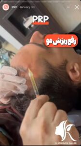 نمونه کار پی آر پی دکتر مژگان کلالی در مشهد