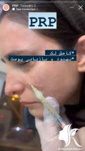 نمونه کار پی آر پی دکتر مژگان کلالی در مشهد