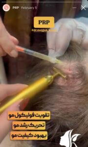 نمونه کار پی آر پی دکتر مژگان کلالی در مشهد