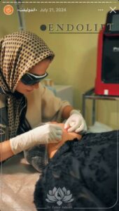 نمونه کار اندولیفت کلینیک سی گل در مشهد