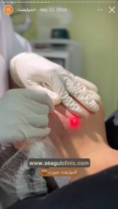 نمونه کار اندولیفت کلینیک سی گل در مشهد