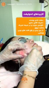 نمونه کار اندولیفت کلینیک سی گل در مشهد