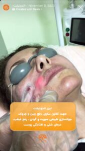 نمونه کار اندولیفت کلینیک سی گل در مشهد