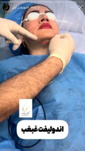 نمونه کار اندولیفت دکتر یوسفیان مقدم در مشهد