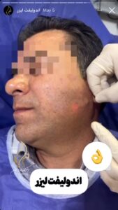 نمونه کار اندولیفت دکتر یوسفیان مقدم در مشهد