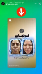 نمونه کار اندولیفت دکتر یوسفیان مقدم در مشهد