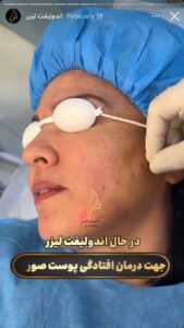 نمونه کار اندولیفت دکتر یوسفیان مقدم در مشهد