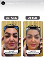 نمونه کار اندولیفت دکتر یوسفیان مقدم در مشهد