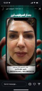 نمونه کار اندولیفت دکتر یوسفیان مقدم در مشهد