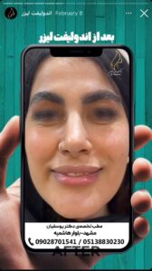 نمونه کار اندولیفت دکتر یوسفیان مقدم در مشهد