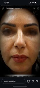 نمونه کار اندولیفت دکتر یوسفیان مقدم در مشهد