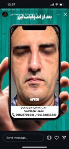 نمونه کار اندولیفت دکتر یوسفیان مقدم در مشهد
