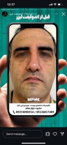 نمونه کار اندولیفت دکتر یوسفیان مقدم در مشهد