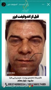 نمونه کار اندولیفت دکتر یوسفیان مقدم در مشهد
