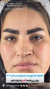 نمونه کار اندولیفت دکتر سلیمان نوری در مشهد