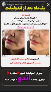 نمونه کار اندولیفت دکتر سلیمان نوری در مشهد