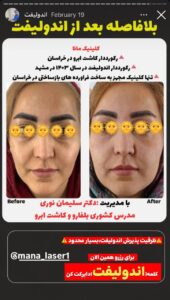 نمونه کار اندولیفت دکتر سلیمان نوری در مشهد