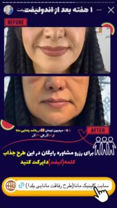نمونه کار اندولیفت دکتر سلیمان نوری در مشهد