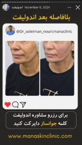 نمونه کار اندولیفت دکتر سلیمان نوری در مشهد