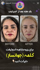 نمونه کار اندولیفت دکتر سلیمان نوری در مشهد