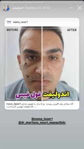 نمونه کار اندولیفت دکتر سلیمان نوری در مشهد