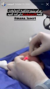 نمونه کار اندولیفت دکتر سلیمان نوری در مشهد
