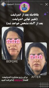نمونه کار اندولیفت دکتر سلیمان نوری در مشهد