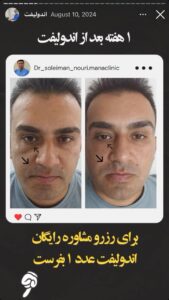 نمونه کار اندولیفت دکتر سلیمان نوری در مشهد