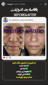 نمونه کار اندولیفت دکتر سلیمان نوری در مشهد