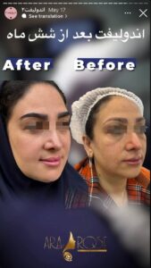 نمونه کار اندولیفت کلینیک آرارز در مشهد