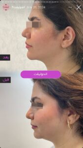 نمونه کار اندولیفت کلینیک آرارز در مشهد
