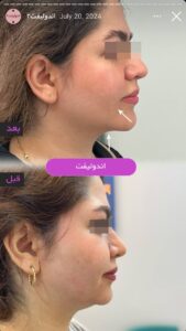 نمونه کار اندولیفت کلینیک آرارز در مشهد