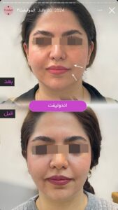 نمونه کار اندولیفت کلینیک آرارز در مشهد