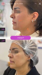 نمونه کار اندولیفت کلینیک آرارز در مشهد