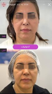 نمونه کار اندولیفت کلینیک آرارز در مشهد