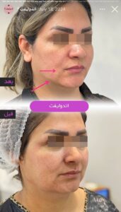 نمونه کار اندولیفت کلینیک آرارز در مشهد