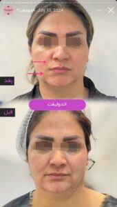 نمونه کار اندولیفت کلینیک آرارز در مشهد