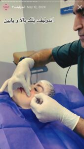 نمونه کار اندولیفت کلینیک آرارز در مشهد