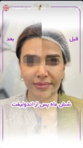 نمونه کار اندولیفت کلینیک آرارز در مشهد