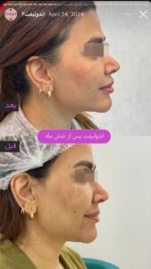 نمونه کار اندولیفت کلینیک آرارز در مشهد